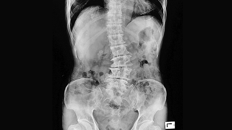 Abordaje minimamente invasivo lateral a la columna lumbar (LLIF o XLIF)