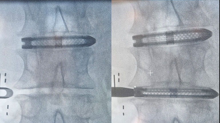 Abordaje minimamente invasivo lateral a la columna lumbar (LLIF o XLIF)