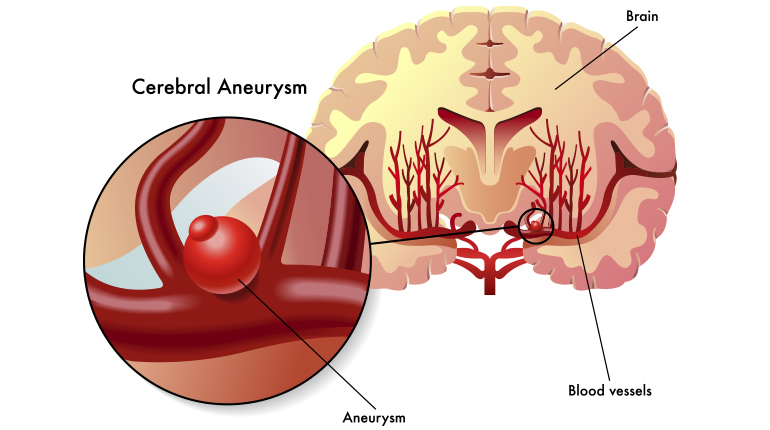 Aneurismas cerebrales