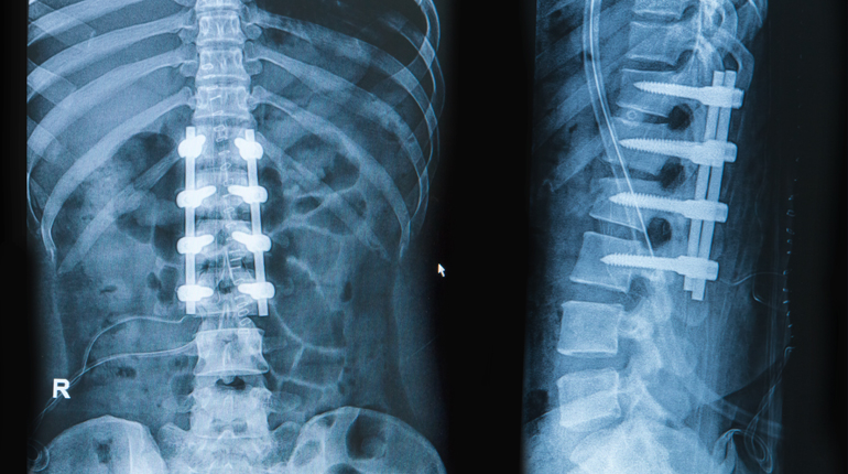 Artrodesis en fracturas vertebrales (MISS)