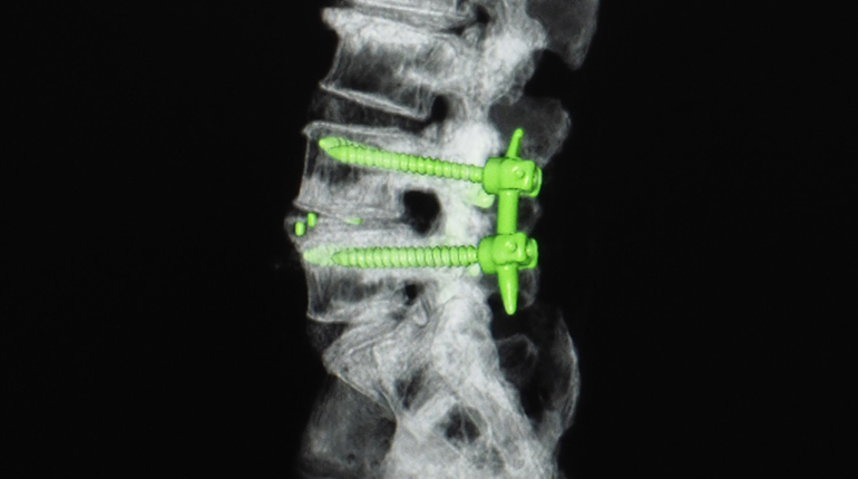 Artrodesis lumbar mínimamente invasiva (MISS)