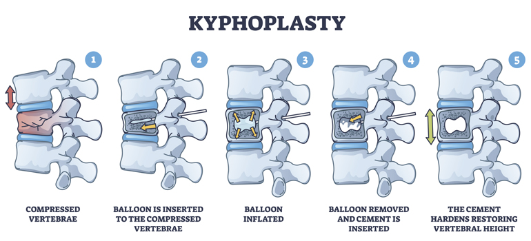 Cifoplastía / Vertebroplastía (MISS)