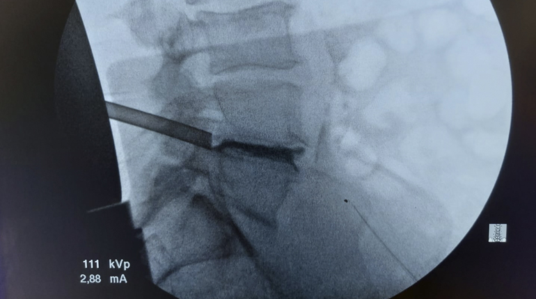 Discectomía endoscópica lumbar