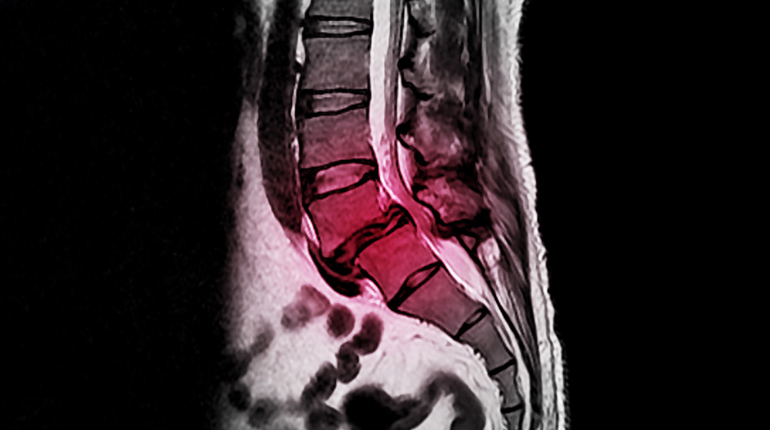 Espondilolistesis