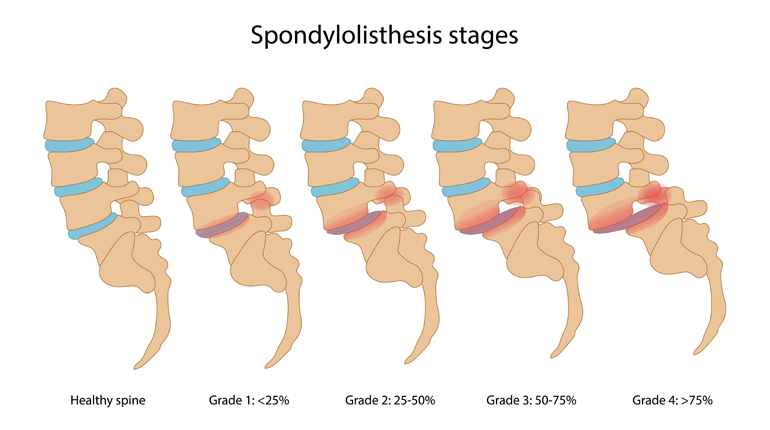 Espondilolistesis