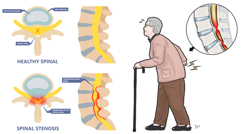 Estenosis de canal lumbar