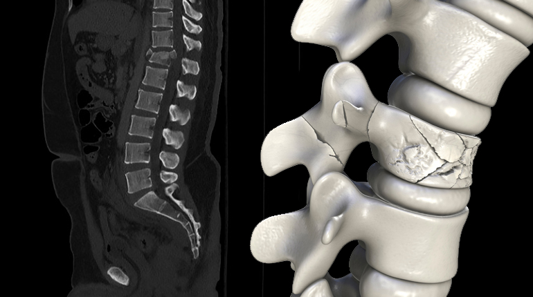 Fracturas vertebrales