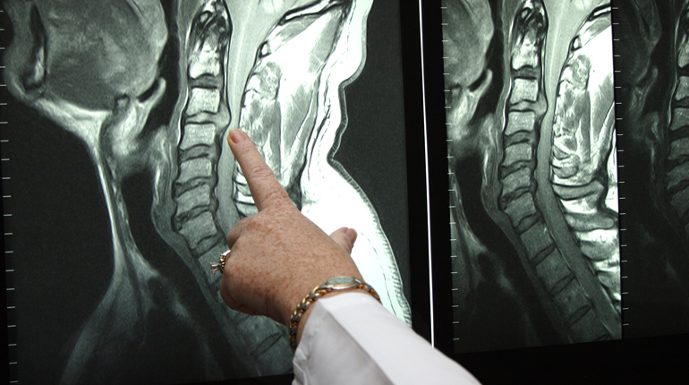 Hernias de disco cervical