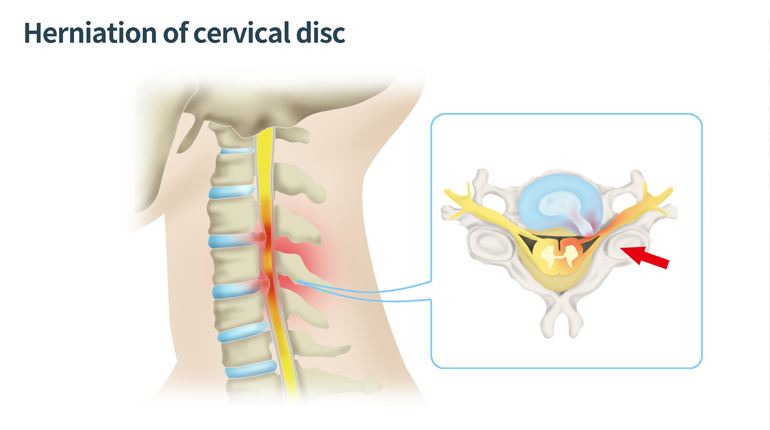 Hernias de disco cervical