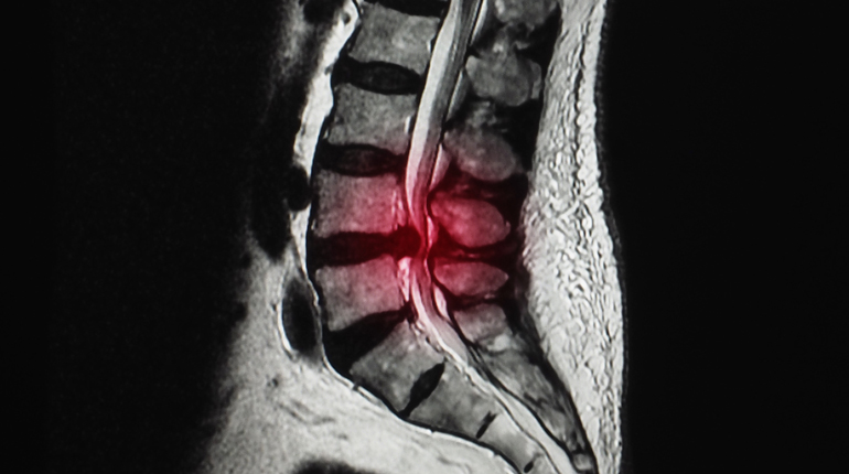 Hernias de disco lumbar