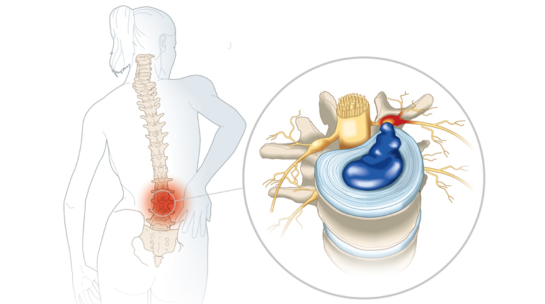 Hernias de disco lumbar