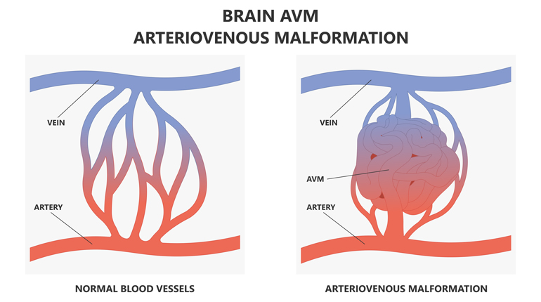 Malformaciones arteriovenosas