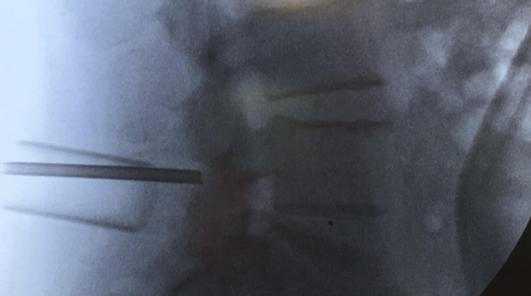 Laminectomía lumbar mínimamente invasiva (MISS)