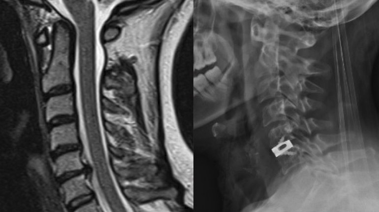 Microdiscectomía y artrodesis cervical anterior (MISS)