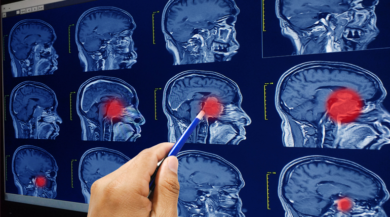 Tumores cerebrales