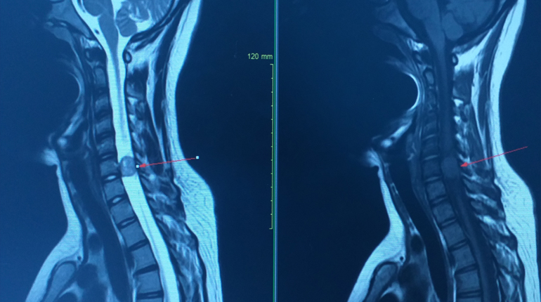 Tumores vertebrales